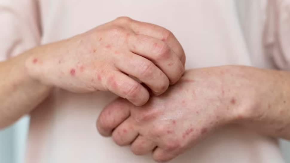 Psoriasis Awareness Month 2023: Identifying Environmental And Lifestyle Factors That Aggravate Symptoms Of This Autoimmune Disease