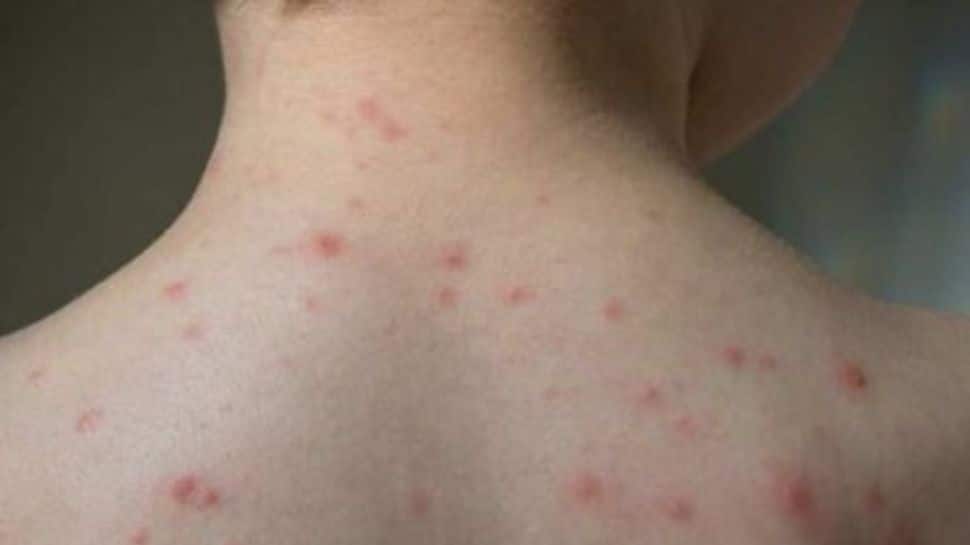 What Is Varicella-Zoster Virus? Check Symptoms And Preventive Measures To Follow 
