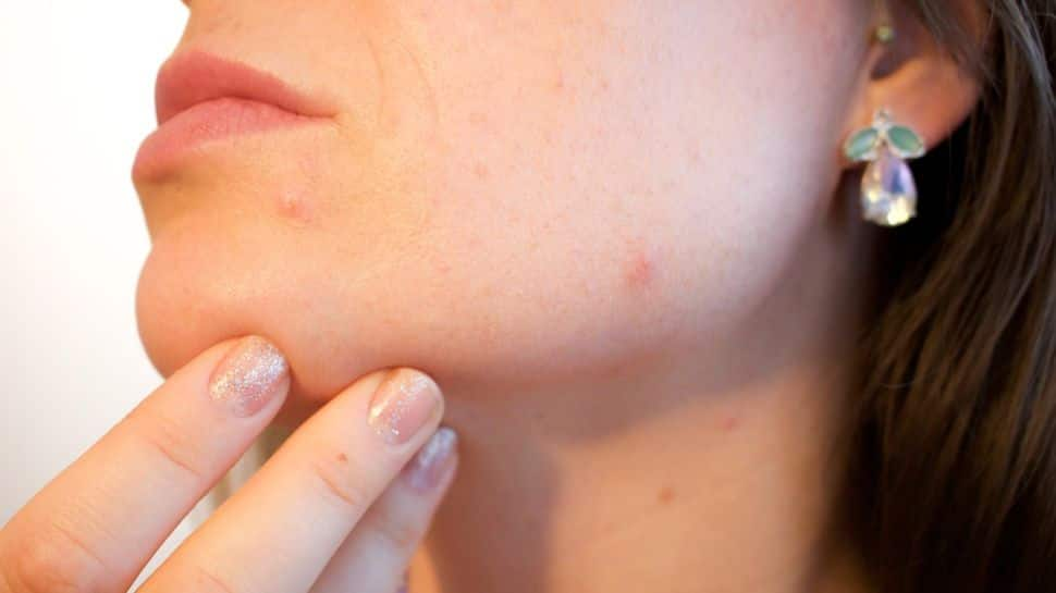 Fertility Treatment Causing Acne, Other Skin Issues? Check Expert&#039;s Advice