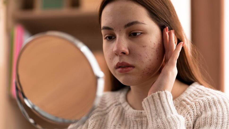 Teenage Acne: 3 Easy Steps To Confidence-Boosting Solutions For Clear Skin