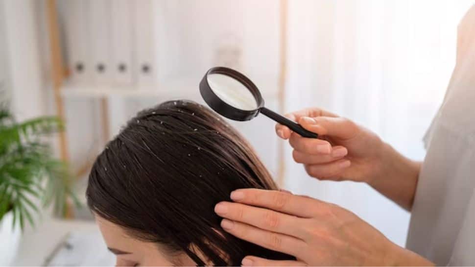 Dandruff Trouble In Winter: How To Keep Scalp Clean, Remedies To Follow