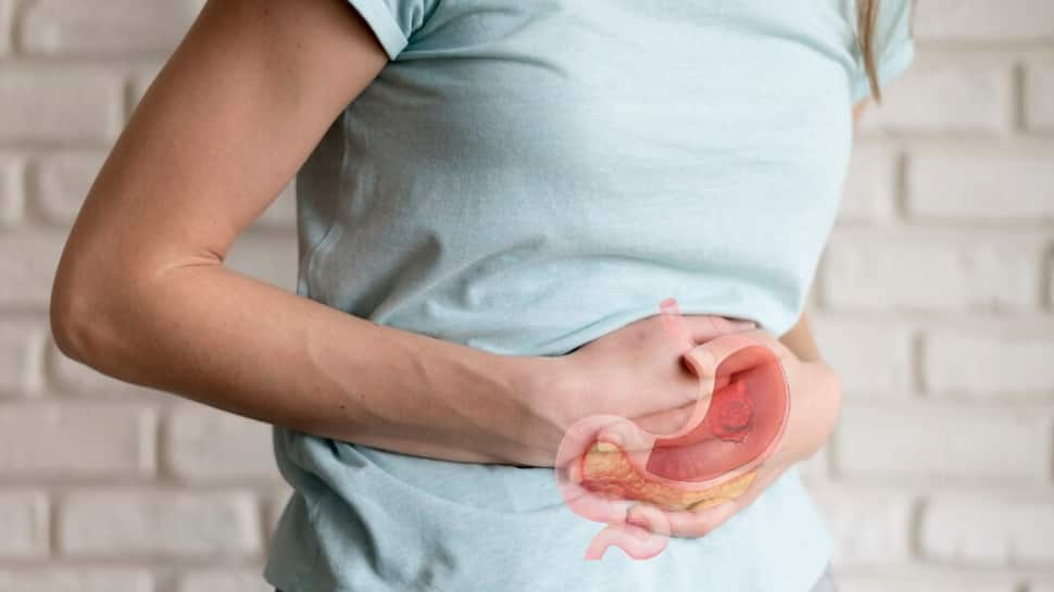 Stomach Cancer: Debunking Myths And Unveiling Facts About Gastric Cancer