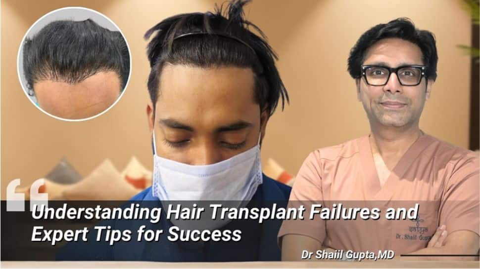 Understanding Hair Transplant Failures and Expert Tips for Success - Vimarsana News