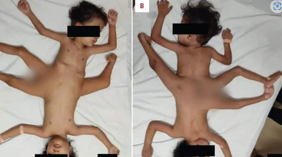 Extremely Rare Conjoined Twins Born In Indonesia Have 4 Arms, 3 Legs