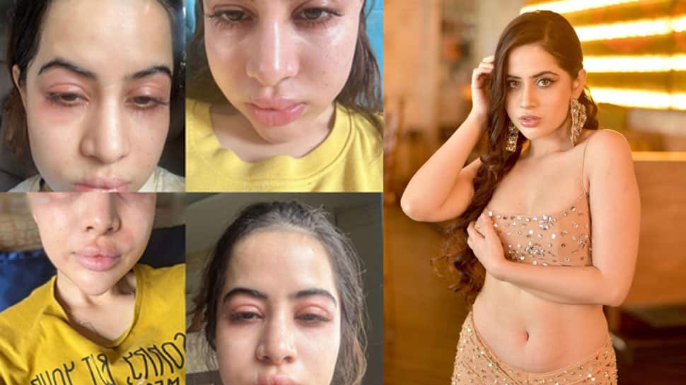 Uorfi Javed Admits Using Fillers And Botox Since She Was 18, Clarifies &#039;Face Swollen Due To Allergies&#039; 