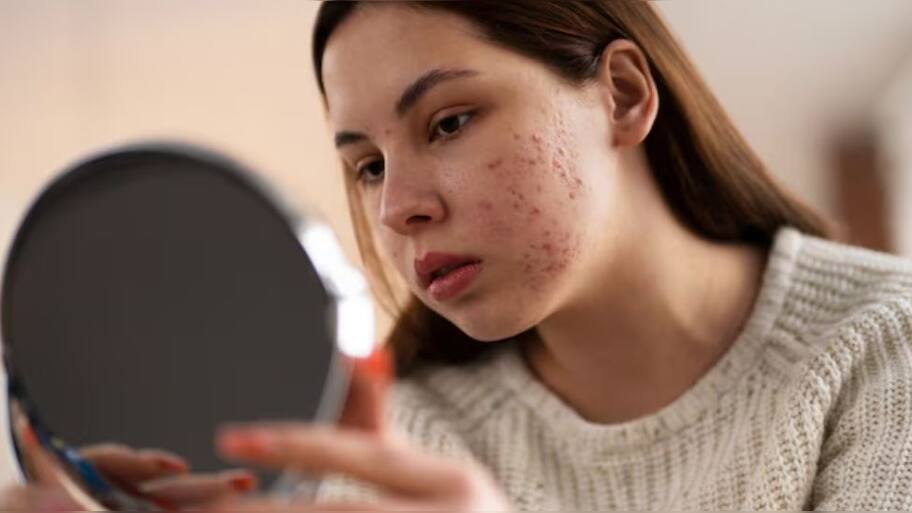 Unmasking The Link: Stress And Skin Issues | Beauty/Fashion News | Zee News