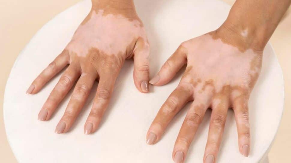 World Vitiligo Day: Special Workshop Raises Awareness About Skin Disease