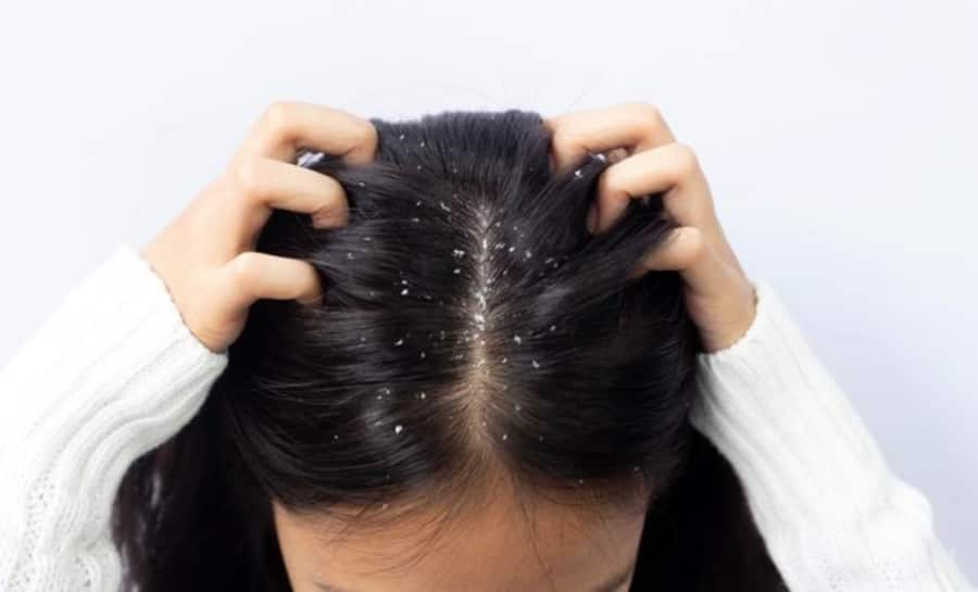 Breaking Myths: Does Applying Oil Reduces Dandruff 