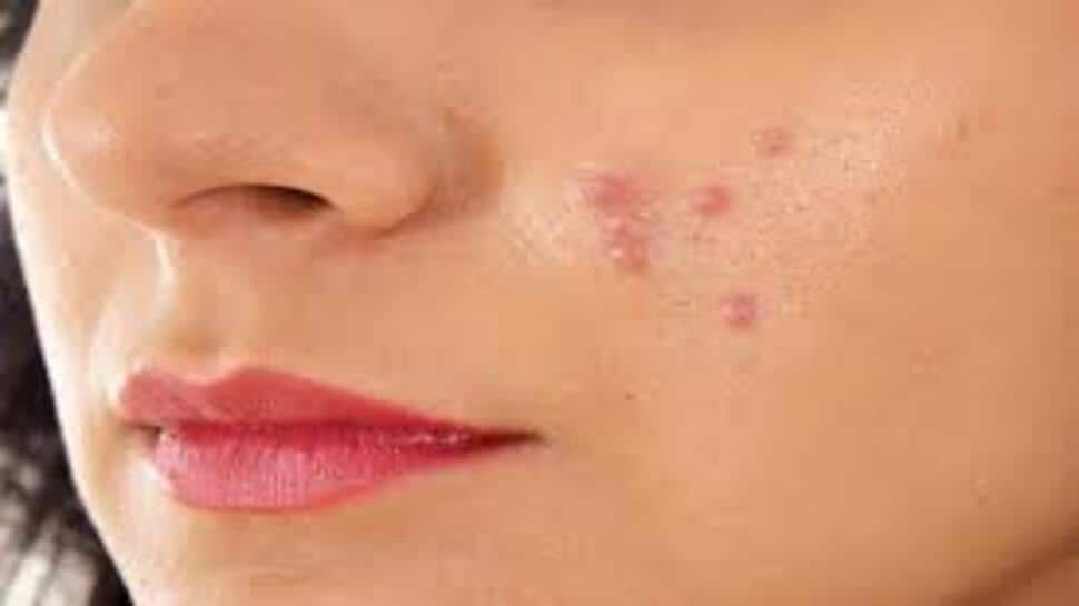 Tips To Get Rid Of Acne Really Quickly