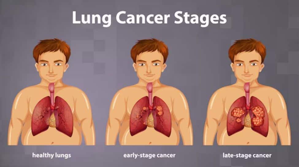 Spotting Lung Cancer: Symptoms, Treatment, And Prevention