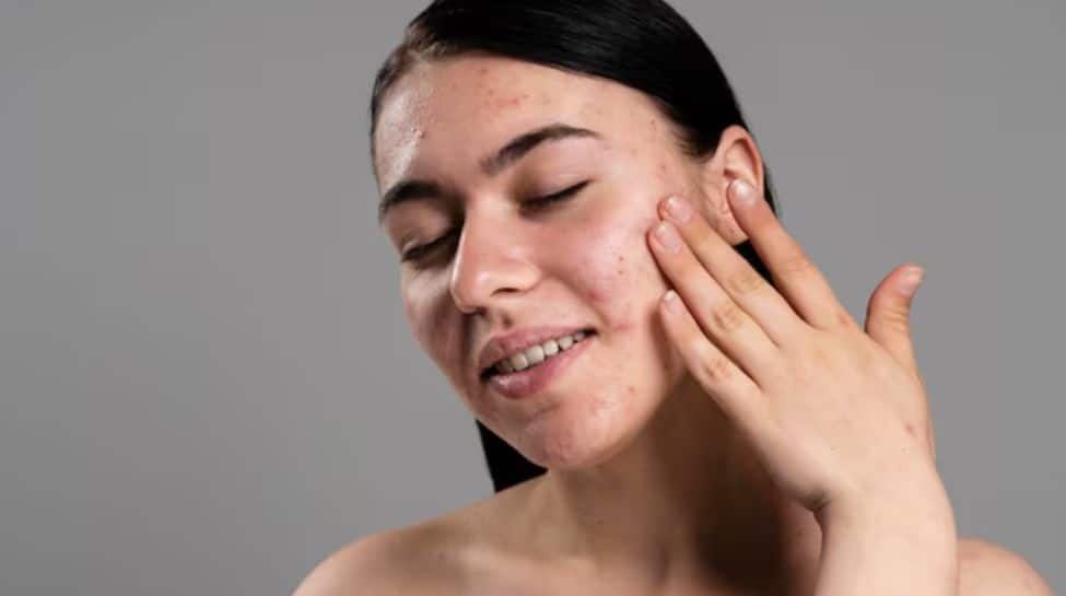 Tips For Managing Oily Skin This Monsoon Season