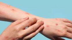 Thailand Confirms Asia’s First Case Of New Mpox Strain
