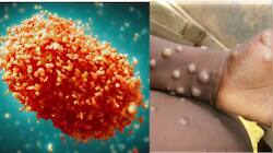 WHO Launches Global Strategic Preparedness and Response Plan to Tackle Mpox 