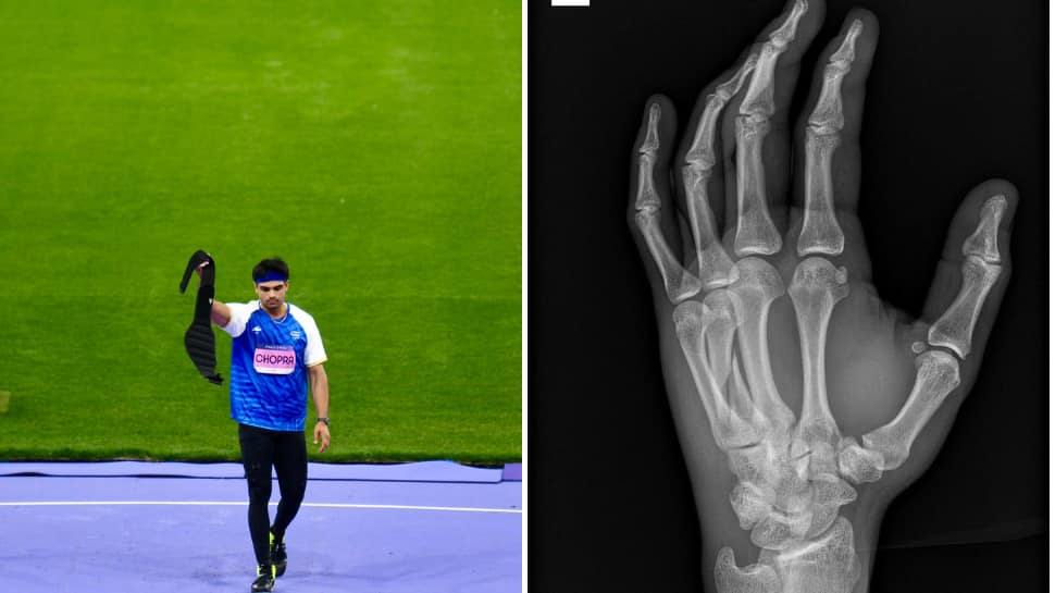 Neeraj Chopra's Shocking Injury News Revealed: Javelin Star Competed With Broken Hand In Diamond League Final 2024