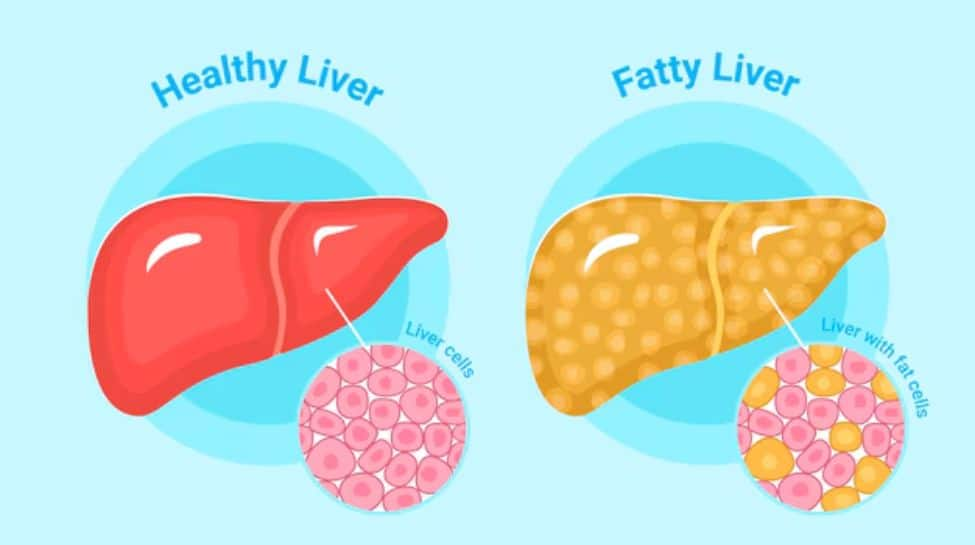 Study Reveals: Good Sleep Patterns Can Prevent Cirrhosis in Non-Alcoholic Fatty Liver Disease Patients