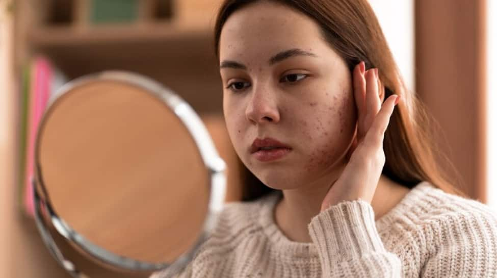 Acne In Your 20s? Know Why It Happens And How To Treat It