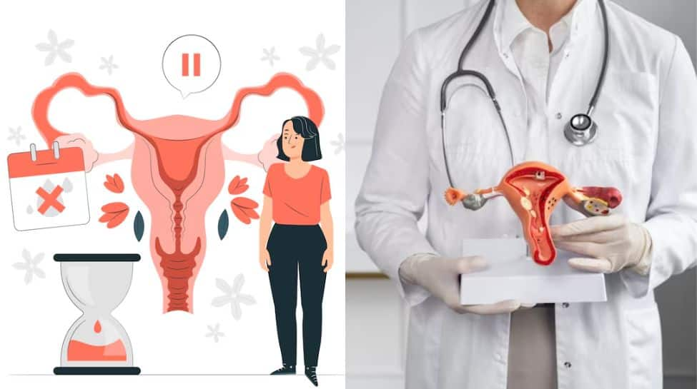 Doctor Explains The Link Between PCOS And Endometrial Cancer: Understanding The Risks