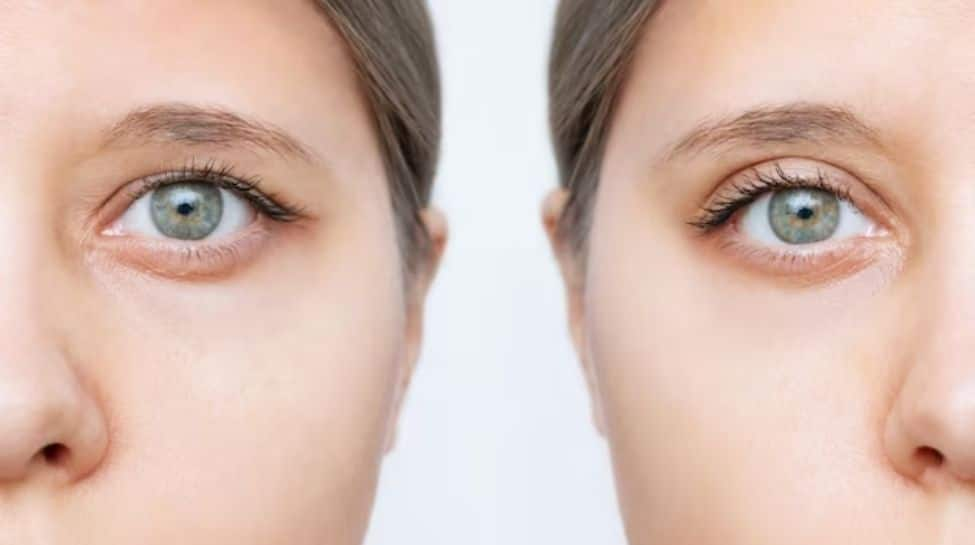 Blepharoplasty: The Rising Popularity Of Eyelid Lifting For A Rejuvenated Look