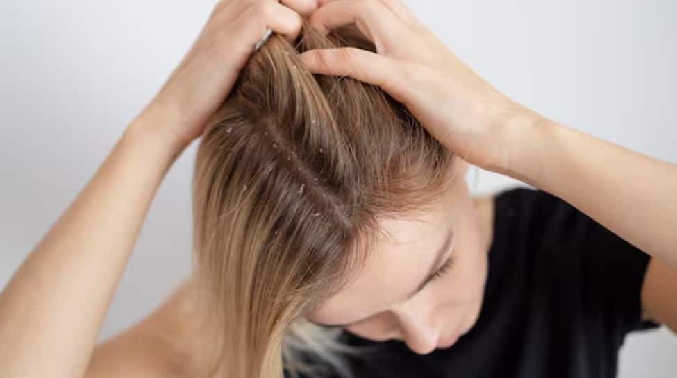 Tired of Dry Scalp in Winter? Here's How to Fix It With DIY Home Remedies