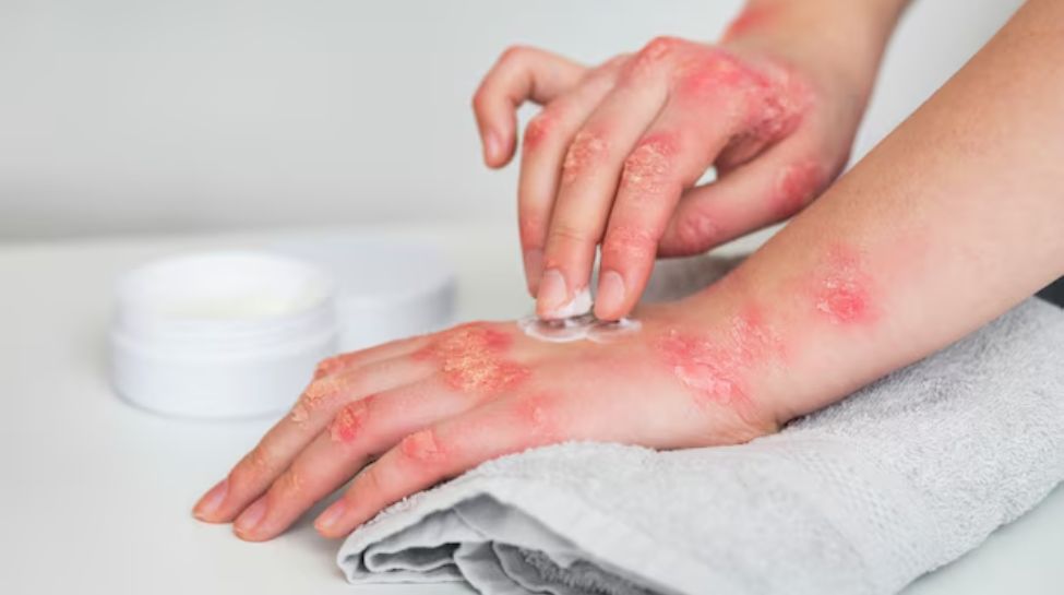 Stay Hydrated, Stay Happy: Winter Survival Guide For Eczema Stay Hydrated, Stay Happy: Winter Survival Guide For Eczema
