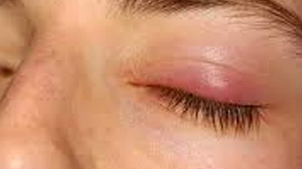 Red, Swollen Eyelids