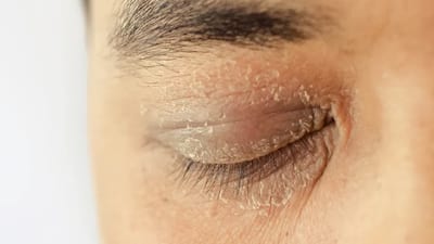 Flaky Skin or Oily Secretions Along the Eyelid