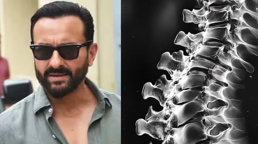 Saif Ali Khan Suffered Thoracic Spinal Chord Injury, Spinal Fluid Leaked: Doc Shares How Dangerous It Is