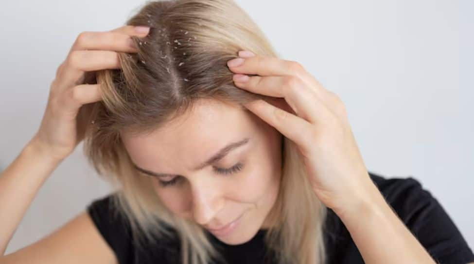 Tips To Nourish The Scalp And Fight Dryness And Flakes; Check Expert Opinion