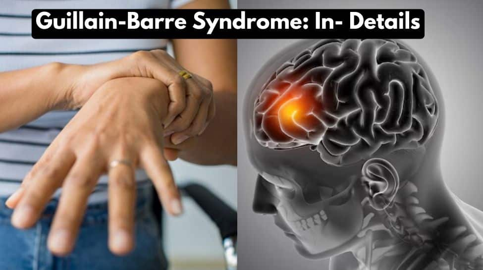 Guillain-Barre Syndrome: Doctor Shares Symptoms, And Preventions For This Rare Severe Neurological Condition