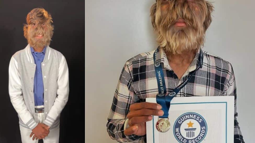 Meet The Indian Teen With The Hairiest Face – A Guinness World Record Holder!- Watch Video Meet The Indian Teen With The Hairiest Face – A Guinness World Record Holder!- Watch Video