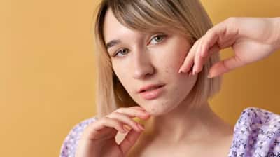 How To Remove Acne Scars Naturally