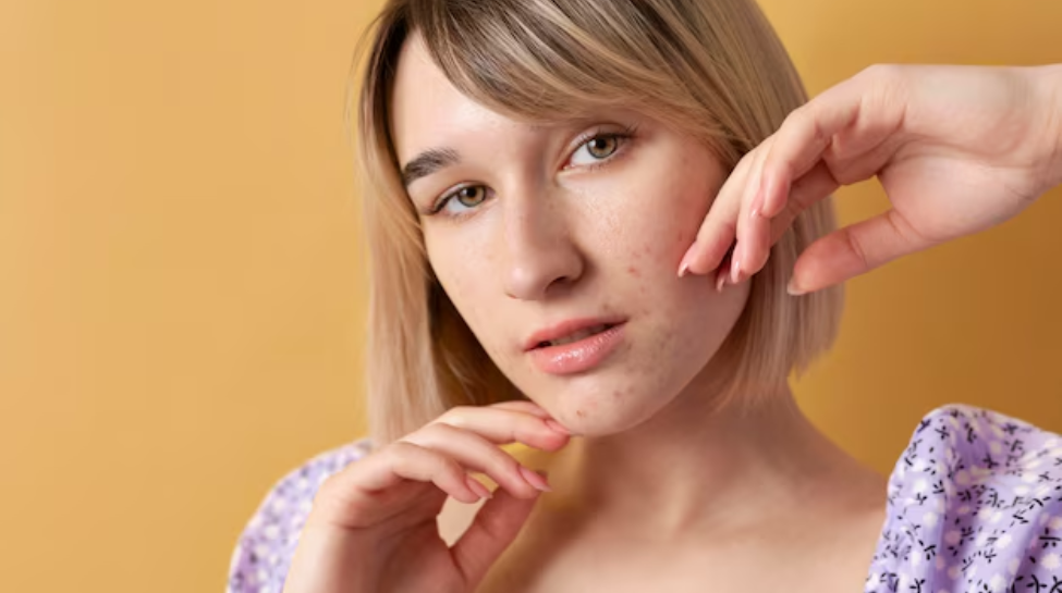 How To Remove Acne Scars Naturally