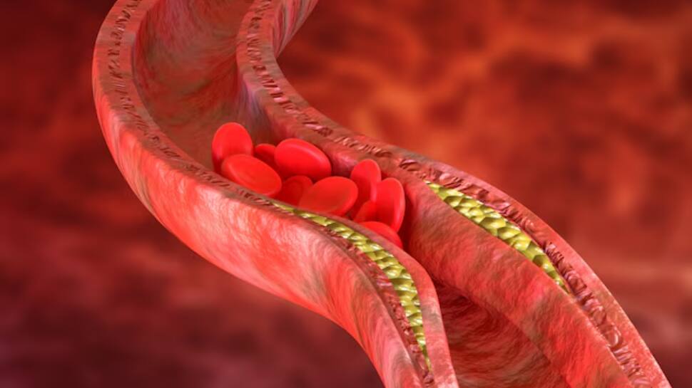 Study Finds Better Way To Predict Heart Disease And Who Needs Statins