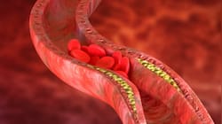 Study Finds Better Way To Predict Heart Disease And Who Needs Statins
