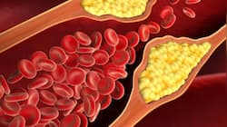 Lowering Bad Cholesterol May Reduce Dementia And Alzheimer’s Risk, Study Finds