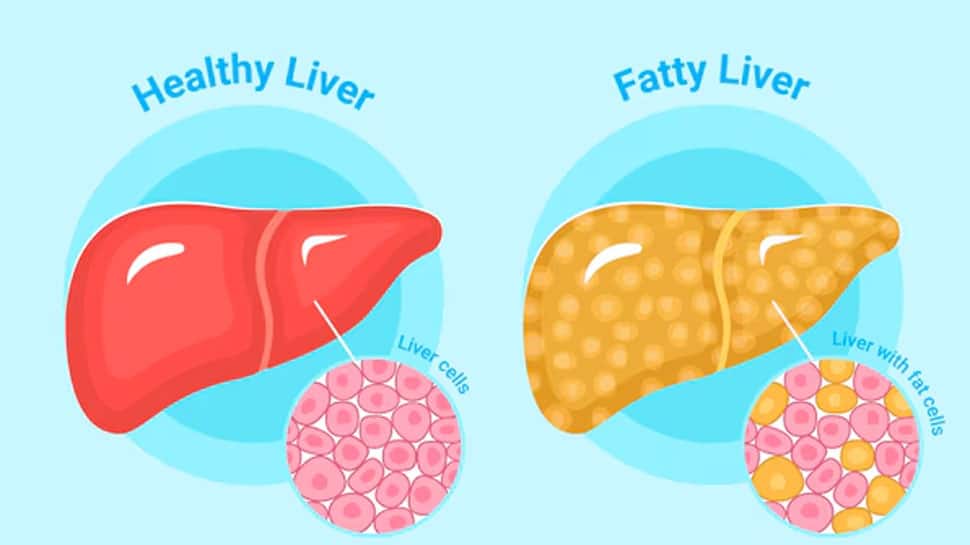 Is Sedentary Lifestyle Linked To Fatty Liver Disease? Expert Advice On MASLD Is Sedentary Lifestyle Linked To Fatty Liver Disease? Expert Advice On MASLD