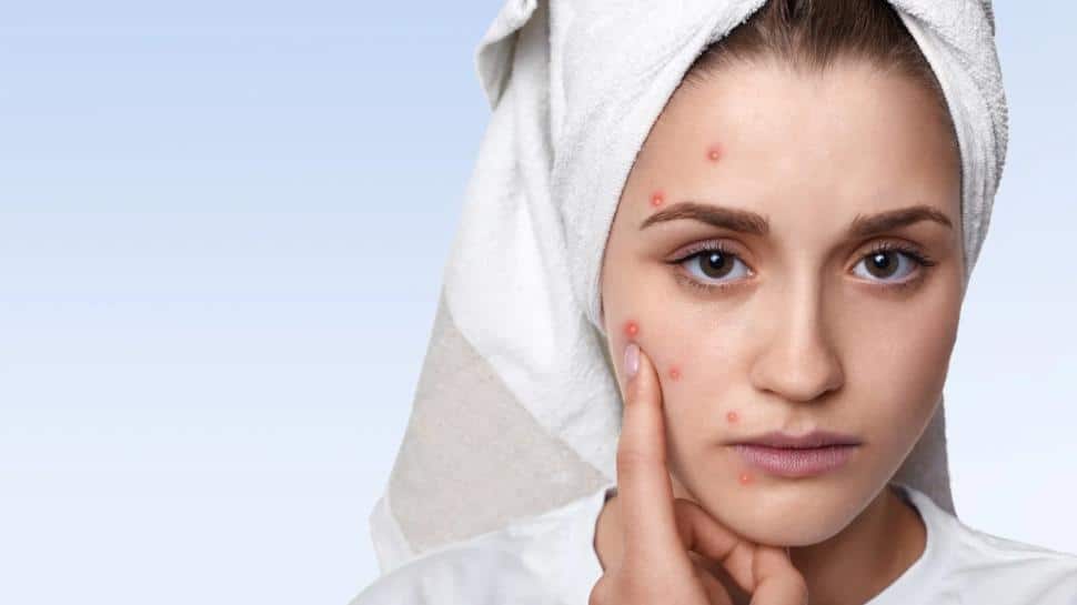 Beating Acne in the Indian Climate: Evening Skincare Routine Beating Acne in the Indian Climate: Evening Skincare Routine