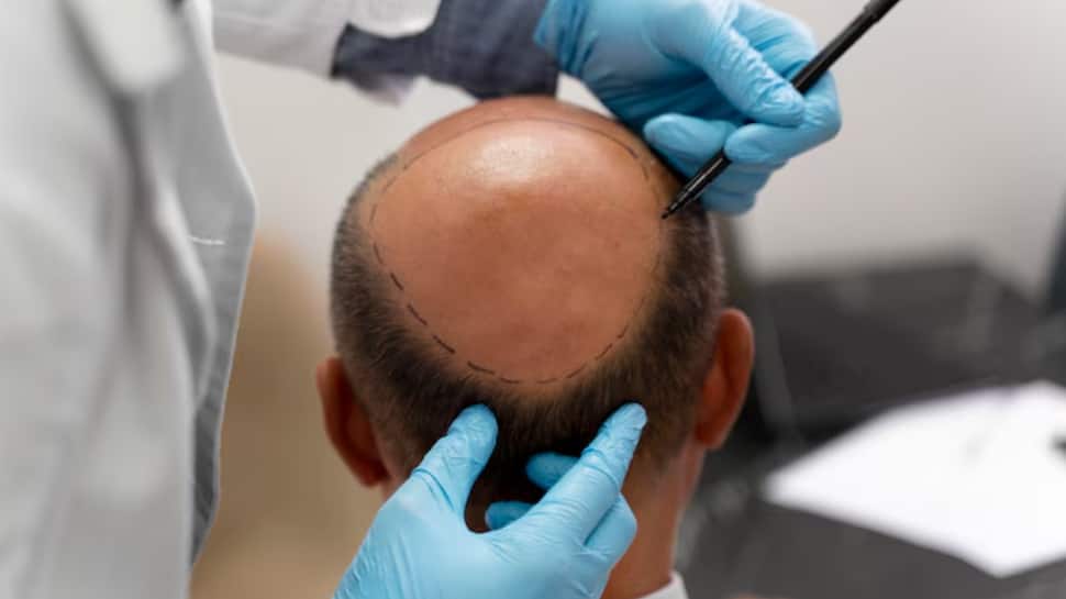 Botched Hair Transplant Surgery Kills Two Men In Kanpur: Expert Reveals What Went Wrong And How You Can Stay Safe