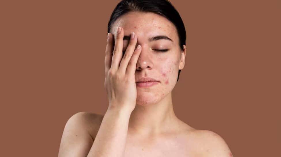 Heat Stroke On Skin: Signs Your Skin Barrier Is Damaged Heat Stroke On Skin: Signs Your Skin Barrier Is Damaged