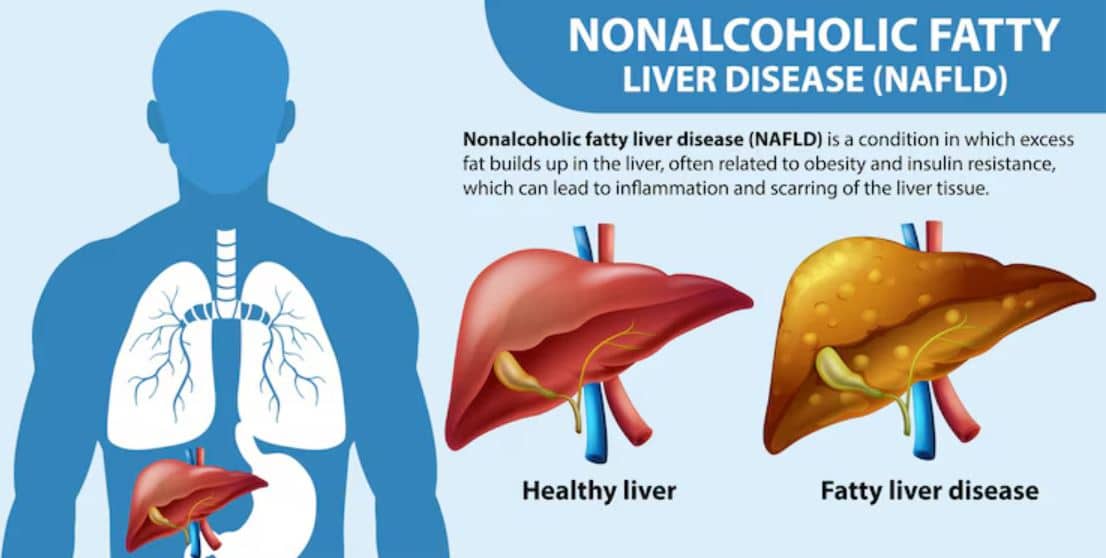 International Yoga Day 2025, yoga for fatty liver, yoga for obesity, best yoga poses to lose weight,