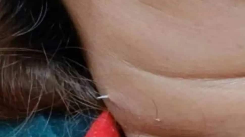 Medical Head-Scratcher: Fish Bone Pierces Woman's Neck Weeks After Soup Meal
