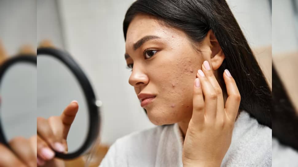 Say Goodbye To Pimples In 24 Hours: 8 Safe And Fast-Acting Methods That Help