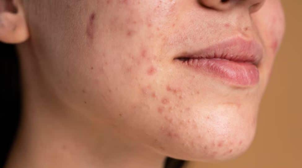 Clear Skin Naturally - Busting Myths Around Pimples And Acne