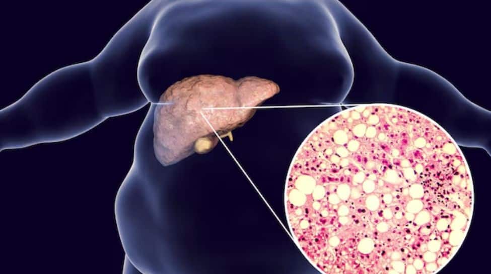 The Role Of Fasting, Detox, And Panchakarma In Managing Fatty Liver Naturally