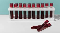 Medical Mystery Unfolds: India Discovers Blood Type Never Seen Before