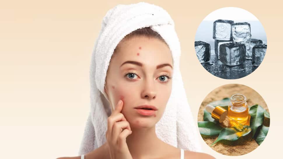 How To Get Rid Of Pimples Naturally: Tea Tree Oil, Honey Masks, And Home Hacks That Really Work For Acne-Prone Skin