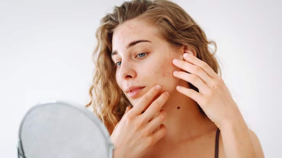 From Blemishes To Beautiful Skin: How To Pop Pimples Safely Without Causing Scars Or Marks