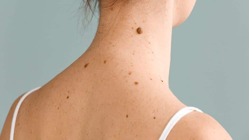 Troubled By Moles On Your Skin? Try These Easy Home Remedies For Naturally Glowing Skin Troubled By Moles On Your Skin? Try These Easy Home Remedies For Naturally Glowing Skin