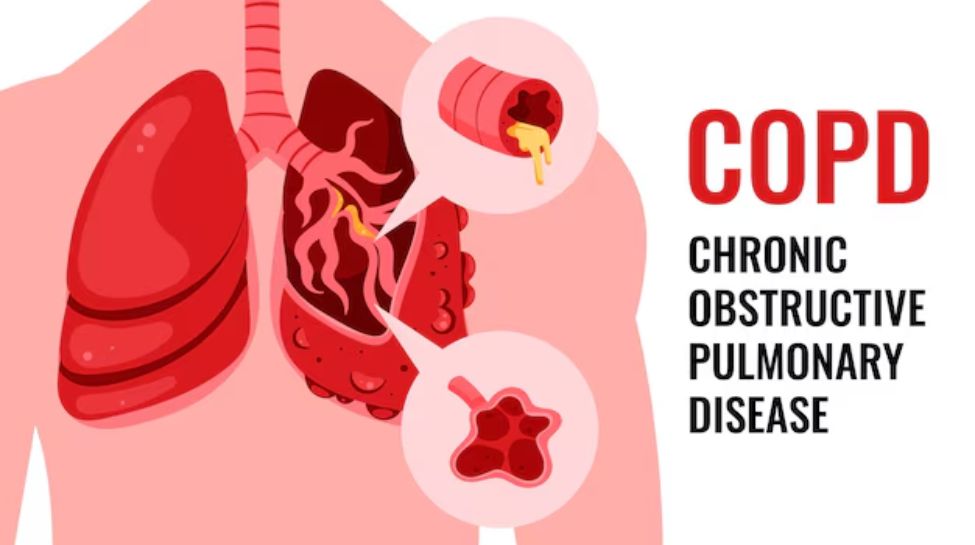 Breathing Easier: How Timely Treatment Can Halt COPD Progression Breathing Easier: How Timely Treatment Can Halt COPD Progression