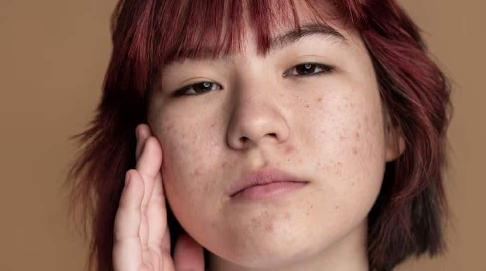 Why Adult Acne Deserves A Real Conversation?